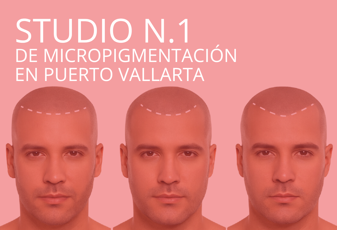 Esta imagen muestra el resultado final de cómo se ve una micropigmentación capilar que se realizó en Puerto Vallarta.
